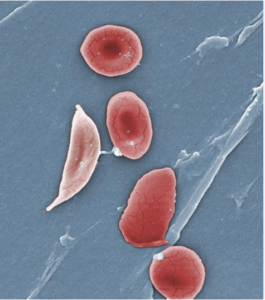 Sickle Cell Disease