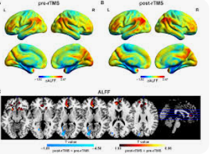 fMRI May Reveal Depression